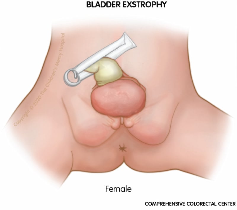 When a girl is born with bladder exstrophy, the bladder and urethra are open and seen as a divided structure (halves) on the outside of the body, and the clitoris may be separated into a right and left half.