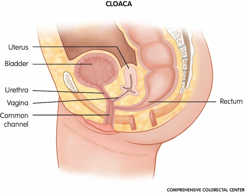 Cloaca is a type of anorectal malformation in which the rectum, vagina and urinary tract are joined. This "common channel" ends in a single opening on the baby's bottom. The external private parts may look normal until closer inspection takes place.