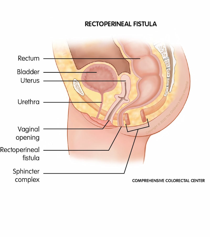 When a baby is born with a rectoperineal fistula, the rectum ends at an opening in the perineum instead of the anus.