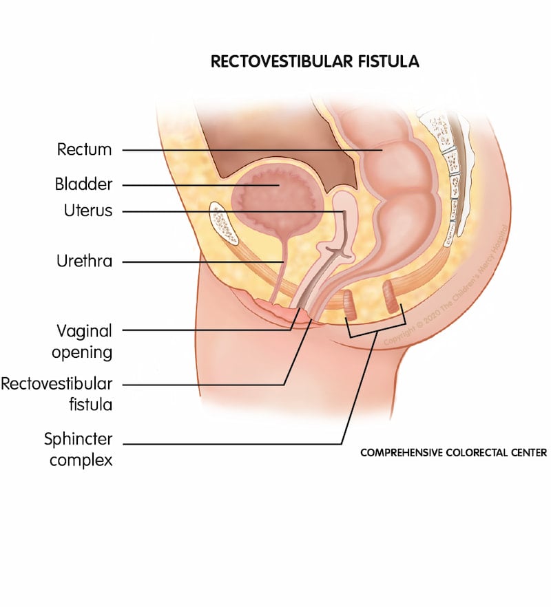 One of the most common female anorectal malformations (ARMs); when a female baby is born with a rectovestibular fistula, her rectum exits near the the vagina instead of through the anal sphincter muscle complex anal opening.