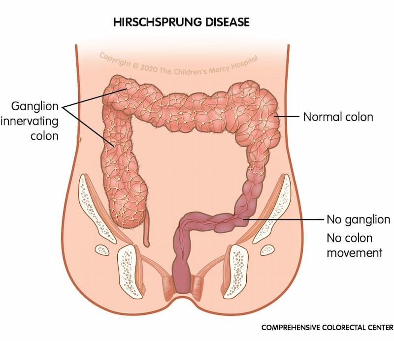 When a baby is born with Hirschsprung disease, part of their colon doesn't have important nerve cells called ganglion cells. Without these ganglion cells, the colon does not eliminate waste (poop) properly.