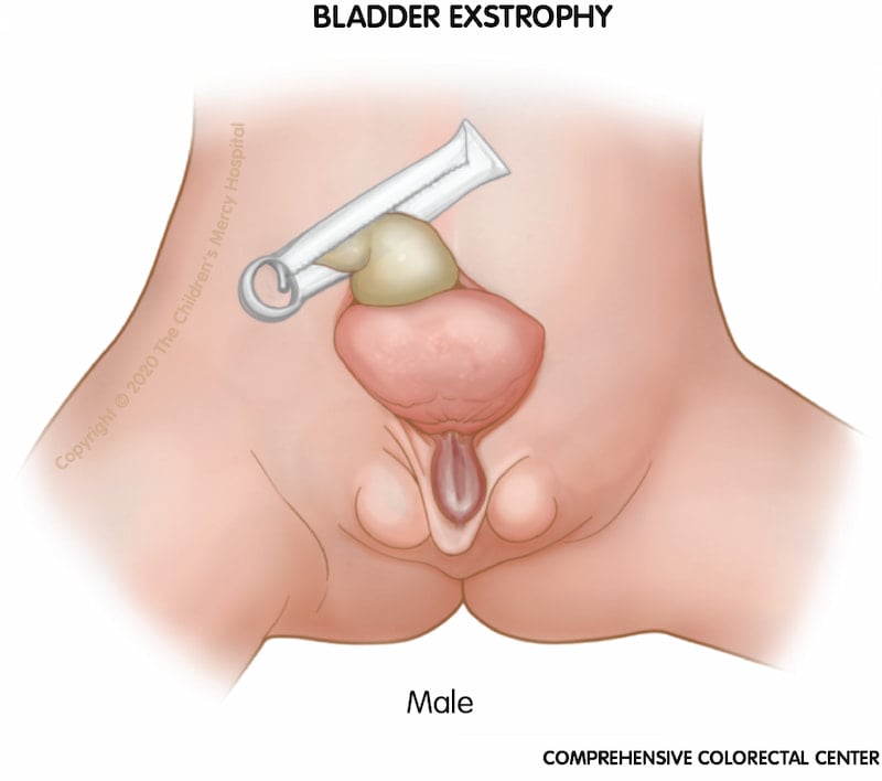 When a boy is born with bladder exstrophy, the bladder and urethra are open and seen as a divided structure (halves) on the outside of the body, the penis may be flat and short, and the top of the penis may open to the bladder.