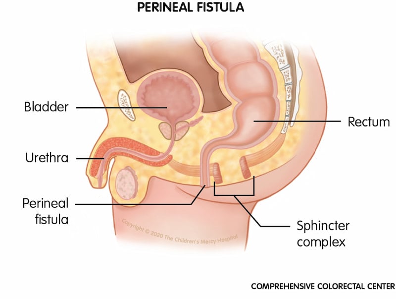 When a baby is born with a perineal fistula, his rectum ends at an opening in the perineum (the space between the urinary and common anal opening area) instead of within the sphincter muscle complex of the anal opening.