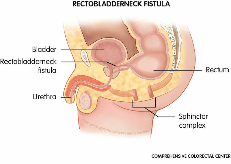 When a baby is born with a rectobladderneck fistula, his rectum connects to the urethra, just below the bladder, instead of to the anus.