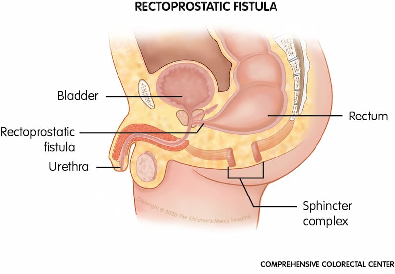 When a baby is born with a rectoprostatic fistula, his rectum connects to the urethra, near the prostate, instead of to the anus.