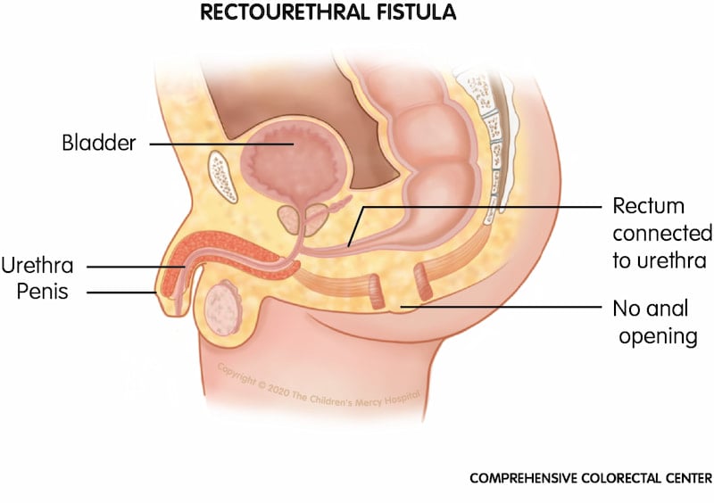 One of the most common male anorectal malformations (ARMs); when a male baby is born with a rectourethral fistula, his rectum is connected to the urethra instead of an anal opening.