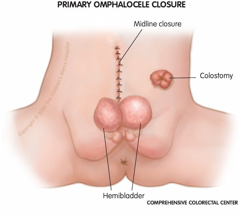 During primary omphalocele surgery, the abdomen is closed (midline closure) with the intestines inside. Part of the colon is directed to a hole in the abdomen to allow poop to exit the body (colostomy). The two halves of the hemibladders are moved closer together.