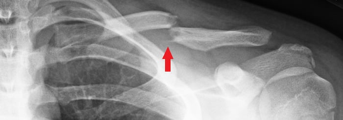 X-ray of the left collarbone (clavicle). The red arrow shows a displaced fracture through the typical location in the middle third of the clavicle shaft. A displaced fracture is when the bone is broken into two or more pieces and the pieces come out of alignment.