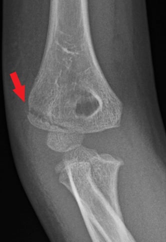 Oblique fracture of the right elbow. The red arrow shows a fracture in the upper arm bone near the elbow (lateral condyle humerus fracture). An oblique fracture is when the bone is broken at an angle.