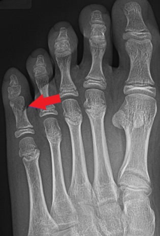Front-view (anteroposterior) x-ray of the left foot. The red arrow shows a fracture of the toe bone closest to the main part of the foot (proximal phalanx) of the fifth toe.