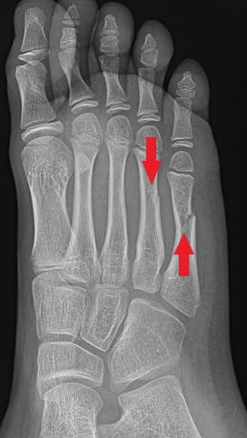 Oblique fracture of the right foot. The red arrows show fractures of two of the long bones in the foot (the 4th and 5th metatarsals). An oblique fracture is when the bone is broken at an angle.