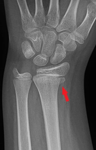 Front-view (anteroposterior) x-ray of the left wrist. The red arrow shows a Salter-Harris II fracture of the forearm near the wrist (distal radius). A Salter-Harris Type II fracture is a fracture that goes through the thicker part of a long bone and the growth plate—a layer of tissue near the ends of a child’s bone—but doesn’t affect the end of the bone.