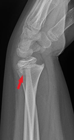 Side-view (lateral) x-ray of the left wrist. The red arrow shows a Salter-Harris II fracture of the forearm near the wrist (distal radius). A Salter-Harris Type II fracture is a fracture that goes through the thicker part of a long bone and the growth plate—a layer of tissue near the ends of a child’s bone—but doesn’t affect the end of the bone.