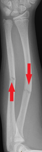 Front-view (anteroposterior) x-ray of the left forearm. The right arrow shows a fracture of the radius shaft and the left arrow shows a fracture of the ulna shaft.