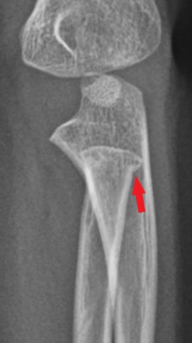 Side-view (lateral) x-ray of the left forearm. The red arrow shows a fracture of the radius bone near the elbow (radial neck).