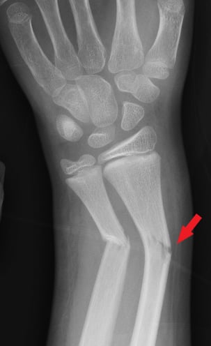 Front-view (anteroposterior) x-ray of the left forearm. The red arrow shows a greenstick fracture of the radius bone (radial shaft). There is also a fracture in the ulna, the other bone in the forearm. A greenstick fracture is when the bone bends or cracks but does not break completely in two.