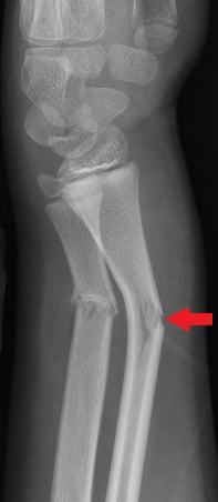 Side-view (lateral) x-ray of the left forearm. The red arrow shows a greenstick fracture of the radius bone (radial shaft). There is also a fracture in the ulna, the other bone in the forearm. A greenstick fracture is when the bone bends or cracks but does not break completely in two.
