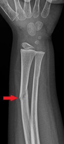 Front-view (anteroposterior) x-ray of the right forearm. The red arrow shows an oblique fracture of the forearm (radial shaft). An oblique fracture is when the bone is broken at an angle.