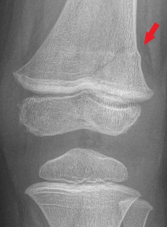 Front-view (anteroposterior) x-ray of the left knee. The red arrow shows a Salter-Harris II fracture of the thigh bone (distal femur). A Salter-Harris Type II fracture is a fracture that goes through the thicker part of a long bone and the growth plate—a layer of tissue near the ends of a child’s bone—but doesn’t affect the end of the bone.