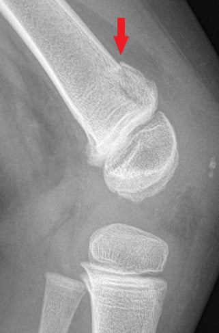 Side-view (lateral) x-ray of the left knee. The red arrow shows a Salter-Harris II fracture of the thigh bone (distal femur). A Salter-Harris Type II fracture is a fracture that goes through the thicker part of a long bone and the growth plate—a layer of tissue near the ends of a child’s bone—but doesn’t affect the end of the bone.