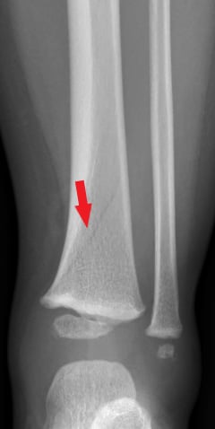 Front-view (anteroposterior) x-ray of the left lower leg bones (tibia/fibula). The red arrow shows an oblique fracture at the ankle (distal) end of the tibia. An oblique fracture is when the bone is broken at an angle.