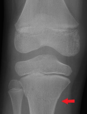 Front-view (anteroposterior) x-ray of the left knee. The red arrow shows a fracture of the shinbone just below the knee (proximal tibia).