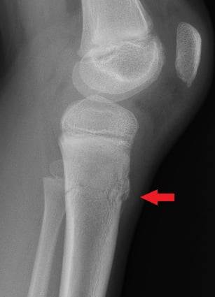 Side-view (lateral) x-ray of the left knee. The red arrow shows a fracture of the shinbone just below the knee (proximal tibia).