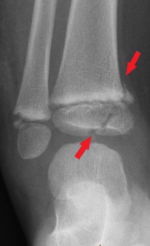 Front-view (anteroposterior) x-ray of the left ankle. The red arrows show a fracture in the shinbone near the foot (distal tibia Salter-Harris IV fracture).  The image also shows a fracture in the other leg bone near the foot (distal fibula Salter-Harris II fracture). Salter-Harris fractures involve the growth plates on the ends of a child’s bones.