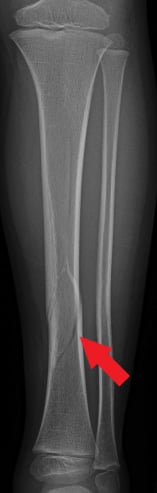 Front-view (anteroposterior) x-ray of the left lower leg bones (tibia/fibula). The red arrow shows a shinbone (tibia) shaft fracture.