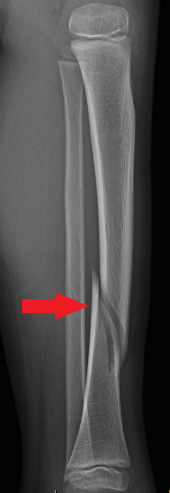 Side-view (lateral) x-ray of the left lower leg bones (tibia/fibula). The red arrow shows a shinbone (tibia) shaft fracture.