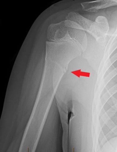 Front-view (anteroposterior) x-ray of the right upper arm bone (humerus). The red arrow shows a fracture of the upper arm bone near the shoulder (proximal humerus).