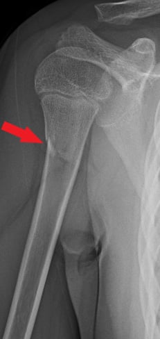 Side-view (lateral) x-ray of the right upper arm bone (humerus). The red arrow shows a fracture of the upper arm bone near the shoulder (proximal humerus).