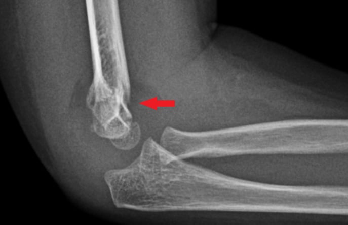 Side-view (lateral) x-ray of the right elbow. The red arrow shows a fracture of the upper arm bone near the elbow (supracondylar humerus fracture).