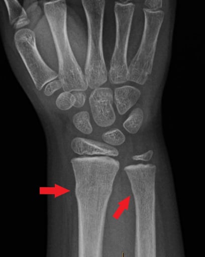 Front-view (anteroposterior) x-ray of the right wrist. The left arrow shows a buckle fracture of the forearm bone (radius) and the right arrow shows a buckle fracture of the other forearm bone (ulna). A buckle fracture is when the bone bends but does not break all the way across.