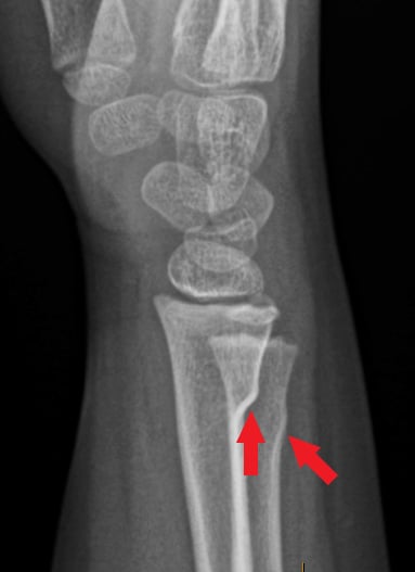 Side-view (lateral) x-ray of the right wrist. The left arrow shows a buckle fracture of the forearm bone (radius) and the right arrow shows a buckle fracture of the other forearm bone (ulna). A buckle fracture is when the bone bends but does not break all the way across.